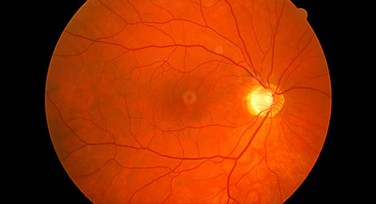 Symptoms and eye examination